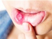 Mô hình học máy chẩn đoán ung thư niêm mạc miệng